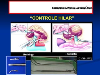 “ CONTROLE HILAR” Nefrectomia Parcial Laparoscópica 