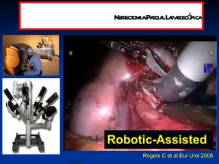 Robotic-Assisted  Rogers C et al Eur Urol 2008 Nefrectomia Parcial Laparoscópica 
