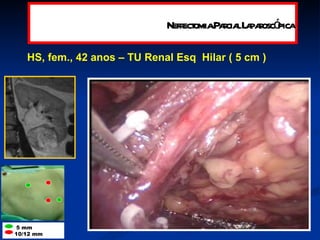 HS, fem., 42 anos – TU Renal Esq  Hilar ( 5 cm ) Nefrectomia Parcial Laparoscópica 5 mm  10/12 mm 