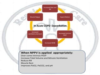 Increased Raw and
RR
Hyperinflation
Increased intrinsic
PEEP
Increased WOB
Increased
ventilatory demand
Muscle fatigue
In Acute COPD Exacerbation
 