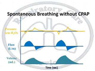 Time (sec)
Flow
(L/m)
Pressure
(cm H2O)
Volume
(mL)
Spontaneous Breathing without CPAP
 