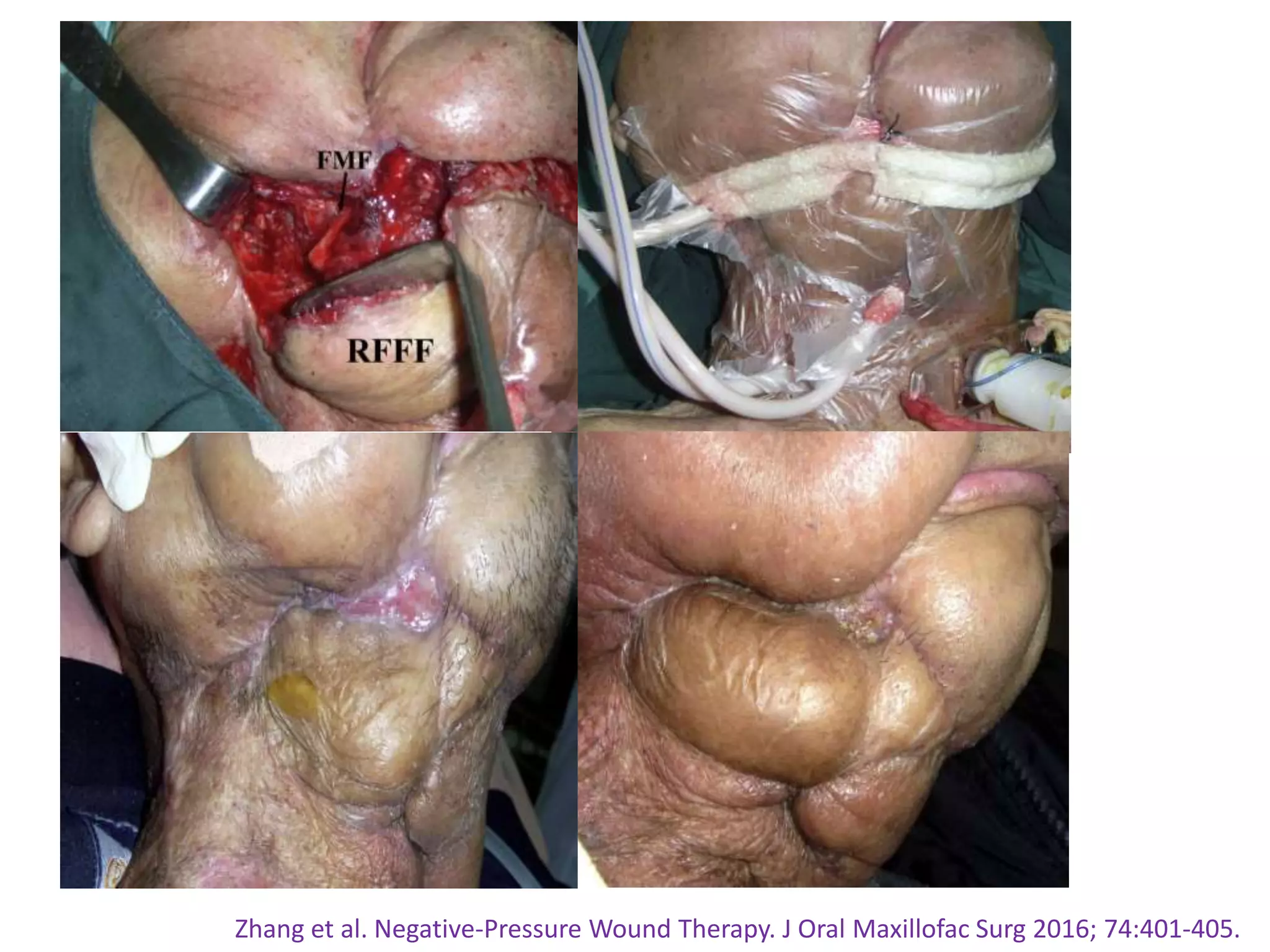 Zhang et al. Negative-Pressure Wound Therapy. J Oral Maxillofac Surg 2016; 74:401-405.
 