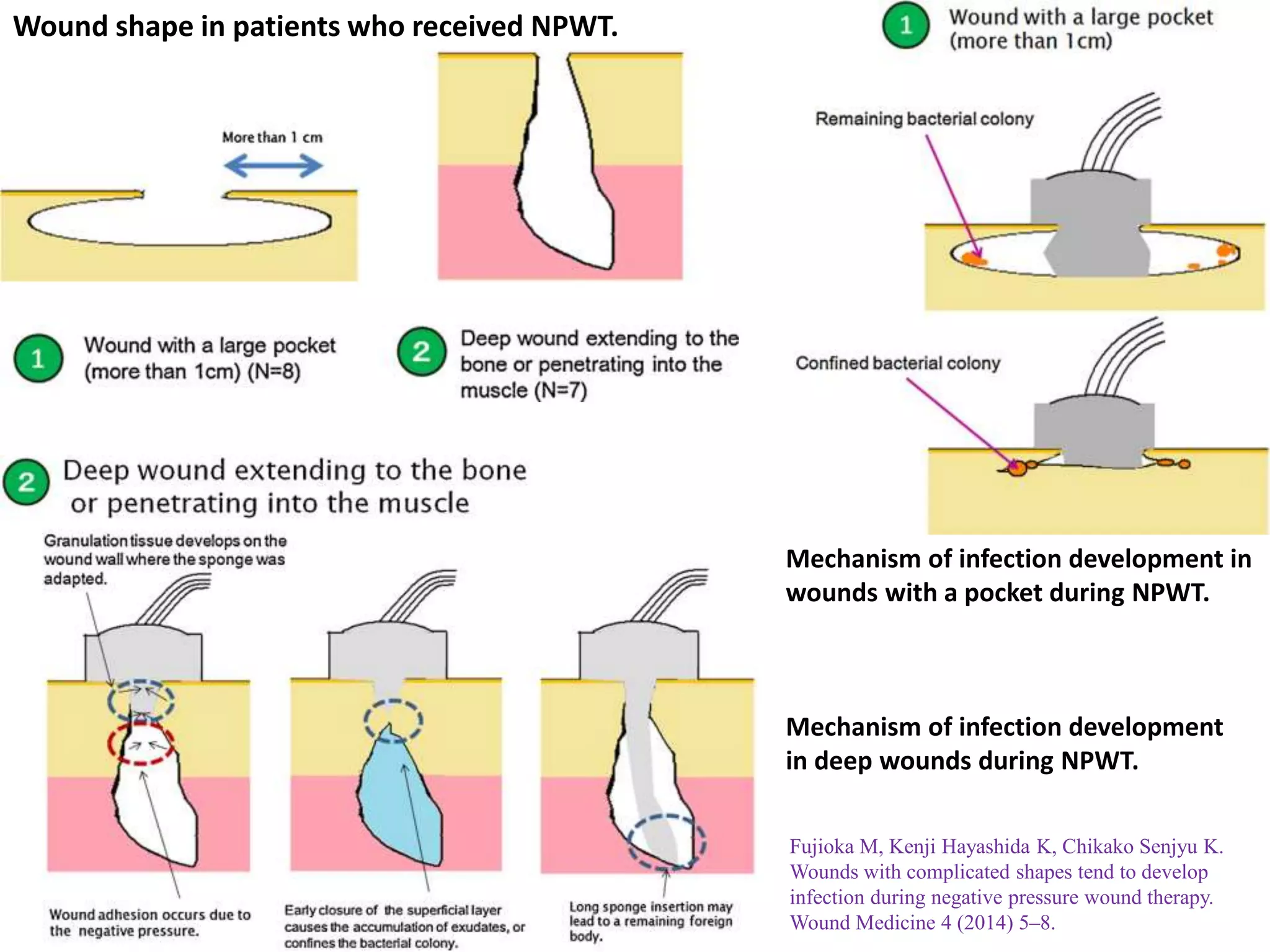 Wound shape in patients who received NPWT.
Mechanism of infection development in
wounds with a pocket during NPWT.
Mechanism of infection development
in deep wounds during NPWT.
Fujioka M, Kenji Hayashida K, Chikako Senjyu K.
Wounds with complicated shapes tend to develop
infection during negative pressure wound therapy.
Wound Medicine 4 (2014) 5–8.
 