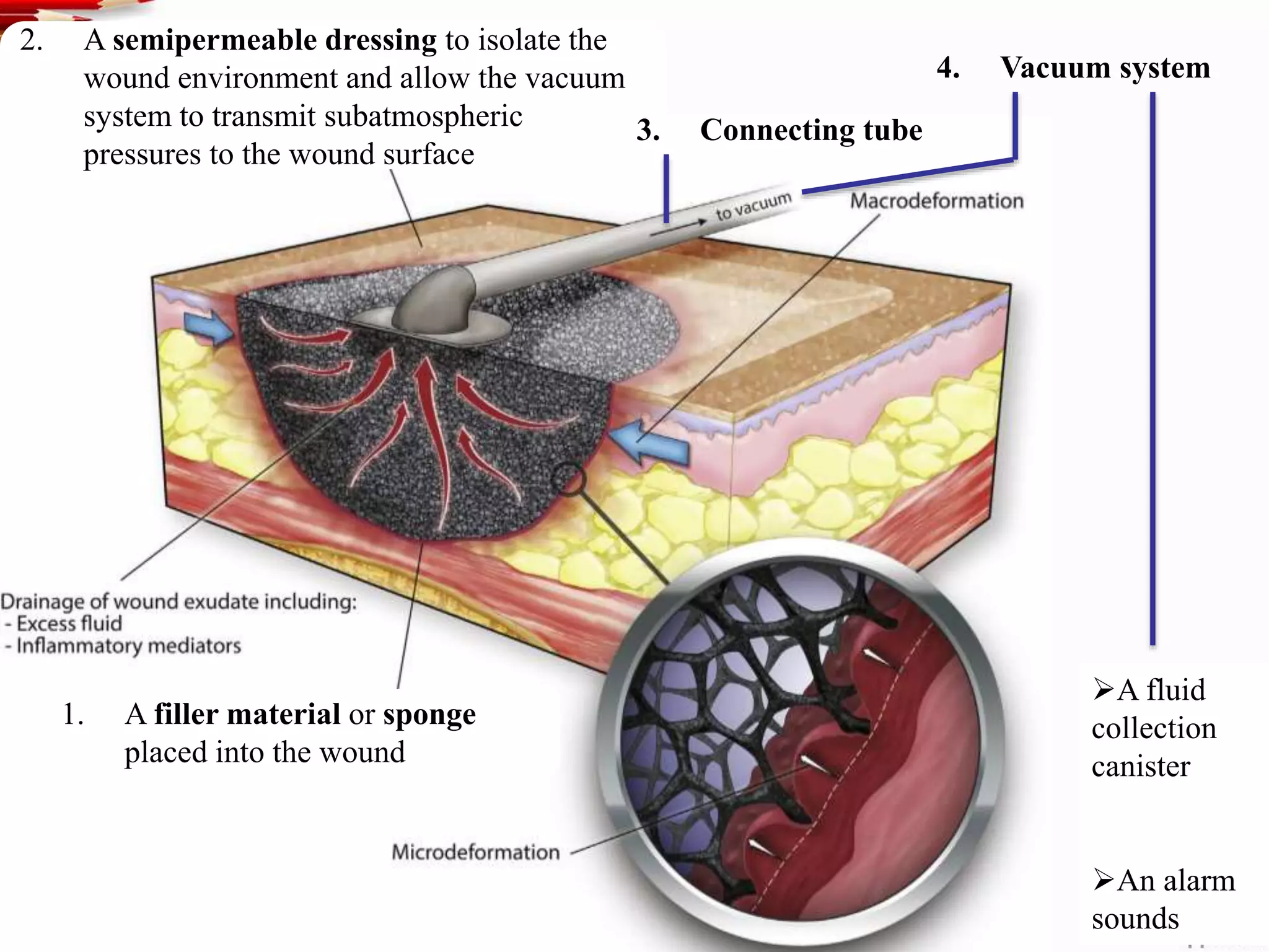 1. A filler material or sponge
placed into the wound
2. A semipermeable dressing to isolate the
wound environment and allow the vacuum
system to transmit subatmospheric
pressures to the wound surface
4. Vacuum system
3. Connecting tube
A fluid
collection
canister
An alarm
sounds
 