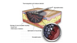 Pressure Injection Wound Negative pressure wound therapy Negative pressure wound therapy | PDF