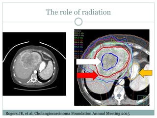 The role of radiation
Rogers JE, et al, Cholangiocarcinoma Foundation Annual Meeting 2015
 