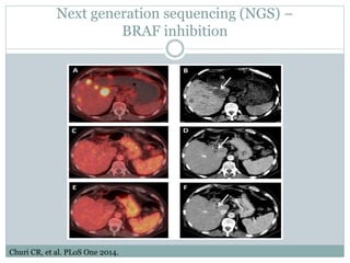 Next generation sequencing (NGS) –
BRAF inhibition
Churi CR, et al. PLoS One 2014.
 
