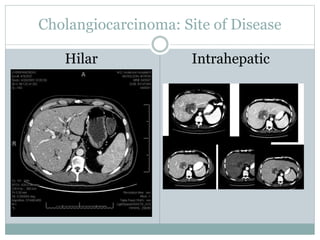 Cholangiocarcinoma: Site of Disease
Hilar Intrahepatic
 