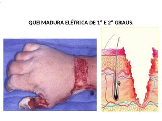 .
QUEIMADURA ELÉTRICA DE 1º E 2º GRAUS.
 