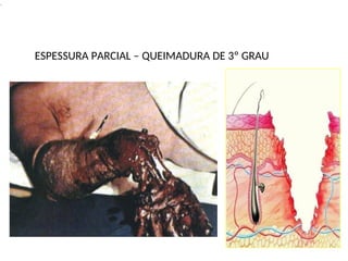 .
ESPESSURA PARCIAL – QUEIMADURA DE 3º GRAU
 