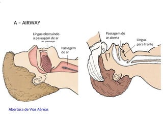 .
A – AIRWAY
Abertura de Vias Aéreas
Passagem
de ar
Língua obstruíndo
a passagem de ar Língua
para frente
Passagem de
ar aberta
 