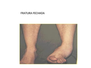 FRATURA FECHADA
 