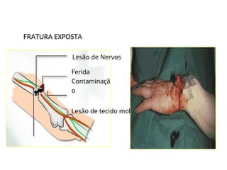 FRATURA EXPOSTA
Lesão de Nervos
Ferida
Contaminaçã
o
Lesão de tecido mole
 
