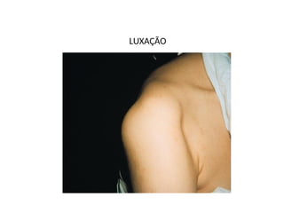 LUXAÇÃO
 
