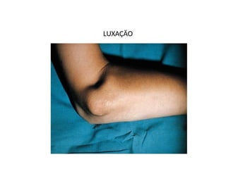 LUXAÇÃO
 
