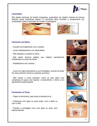 191
Lacerações:
São lesões teciduais de bordos irregulares, produzidas por objetos através de trauma
fechado sobre superfícies ósseas. O socorrista deve controlar o sangramento por
compressão direta e aplicação de curativo e bandagens.
Ferimento nos Olhos:
- Causam lacrimejamento, dor e coceira;
- Levar imediatamente a um especialista;
- Não esfregue ou aperte os olhos;
- Não tentar remover objetos que estejam parcialmente
introduzidos no corpo da vítima;
- Estabilizá-los com curativo;
- Lavar com água abundante ou soro fisiológico, quando se tratar
de corpo estranho móvel ou produtos químicos;
- Não saindo o corpo estranho, cubra os dois olhos com
compressa de gaze, sem apertar, e encaminhar a vítima a um
atendimento especializado.
Ferimentos no Tórax:
- Tapar os ferimentos, para evitar a entrada de ar;
- Pressionar com gaze ou pano limpo, com o dedo ou
com a mão;
- Prender a bandagem com uma faixa ou cinto, sem
apertar demais.
 
