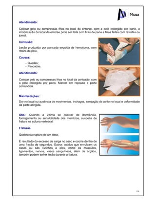 196
Atendimento:
Colocar gelo ou compressas frias no local da entorse, com a pele protegida por pano, a
imobilização do local da entorse pode ser feita com tiras de pano e talas feitas com revistas ou
jornal.
Contusão:
Lesão produzida por pancada seguida de hematoma, sem
rotura da pele.
Causas:
- Quedas;
- Pancadas.
Atendimento:
Colocar gelo ou compressas frias no local da contusão, com
a pele protegida por pano. Manter em repouso a parte
contundida.
Manifestações:
Dor no local ou ausência de movimentos, inchaços, sensação de atrito no local e deformidade
da parte atingida.
Obs.: Quando a vítima se queixar de dormência,
formigamento ou sensibilidade dos membros, suspeite de
fratura na coluna vertebral.
Fraturas
Quebra ou ruptura de um osso.
È resultado do excesso de carga no osso e ocorre dentro de
uma fração de segundos. Outros tecidos que envolvam os
ossos ou são vizinhos a eles, como os músculos,
ligamentos, nervos, vasos sanguíneos, além de órgãos,
também podem sofrer lesão durante a fratura.
 