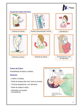 199
Causas de Lesões Cervicais:
Fratura de Crânio:
Possibilidade de lesão no cérebro.
Sintomas:
- Lesões na cabeça;
- Perda de sangue pelo nariz, boca ou ouvidos;
- Tonturas progressivas, com desmaios,
- Dores de cabeça e enjôo;
- Alterações nas pupilas;
- Inconsciência.
Acidente de trânsito
Piscinas ou praias
Quedas (desaceleração vertical)
Rotação da cabeça
Lateralização
Compressão por cinto
de segurança
 