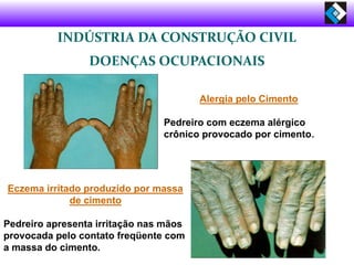 INDÚSTRIA DA CONSTRUÇÃO CIVIL
DOENÇAS OCUPACIONAIS
Alergia pelo Cimento
Pedreiro com eczema alérgico
crônico provocado por cimento.
Eczema irritado produzido por massa
de cimento
Pedreiro apresenta irritação nas mãos
provocada pelo contato freqüente com
a massa do cimento.
 