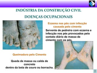 INDÚSTRIA DA CONSTRUÇÃO CIVIL
DOENÇAS OCUPACIONAIS
Eczema nos pés com infecção
causada pelo cimento
Servente de pedreiro com eczema e
infecção nos pés provocados pelo
contato diário de massa de
cimento com os pés.
Queimadura pelo Cimento
Queda de massa ou calda de
concreto
dentro da bota de couro ou borracha.
 