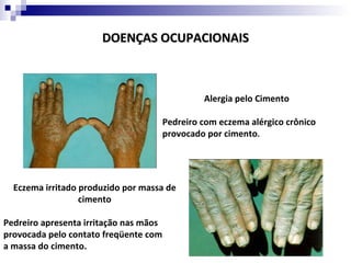 DOENÇAS OCUPACIONAIS



                                                 Alergia pelo Cimento

                                        Pedreiro com eczema alérgico crônico
                                        provocado por cimento.




  Eczema irritado produzido por massa de
                  cimento

Pedreiro apresenta irritação nas mãos
provocada pelo contato freqüente com
a massa do cimento.
 