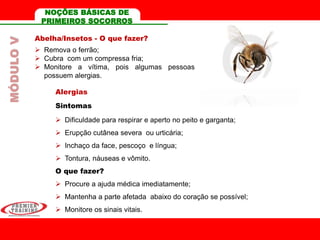 Abelha/Insetos - O que fazer?
 Remova o ferrão;
 Cubra com um compressa fria;
 Monitore a vítima, pois algumas pessoas
possuem alergias.
Alergias
Sintomas
 Dificuldade para respirar e aperto no peito e garganta;
 Erupção cutânea severa ou urticária;
 Inchaço da face, pescoço e língua;
 Tontura, náuseas e vômito.
O que fazer?
 Procure a ajuda médica imediatamente;
 Mantenha a parte afetada abaixo do coração se possível;
 Monitore os sinais vitais.
MÓDULOV NOÇÕES BÁSICAS DE
PRIMEIROS SOCORROS
 