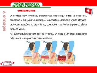 QUEIMADURAS
O contato com chamas, substâncias super-aquecidas, a exposição
excessiva à luz solar e mesmo à temperatura ambiente muito elevada,
provocam reações no organismo, que podem se limitar à pele ou afetar
funções vitais.
As queimaduras podem ser de 1º grau, 2º grau e 3º grau, cada uma
delas com suas próprias características.
MÓDULOV NOÇÕES BÁSICAS DE
PRIMEIROS SOCORROS
 
