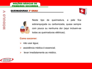 QUEIMADURAS 3º GRAU
Neste tipo de queimadura, a pele fica
esbranquiçada ou carbonizada, quase sempre
com pouca ou nenhuma dor (aqui incluem-se
todas as queimaduras elétricas).
Como socorrer:
 não usar água;
 assistência médica é essencial;
 levar imediatamente ao médico.
MÓDULOV NOÇÕES BÁSICAS DE
PRIMEIROS SOCORROS
 
