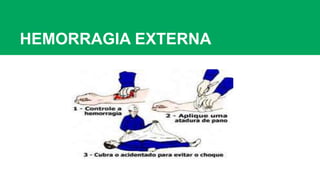 HEMORRAGIA EXTERNA
 
