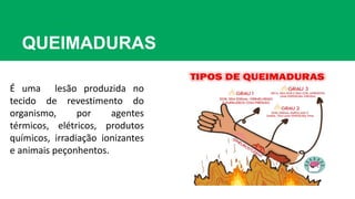 QUEIMADURAS
É uma lesão produzida no
tecido de revestimento do
organismo, por agentes
térmicos, elétricos, produtos
químicos, irradiação ionizantes
e animais peçonhentos.
 