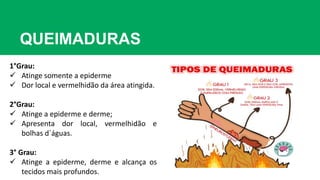 QUEIMADURAS
1°Grau:
 Atinge somente a epiderme
 Dor local e vermelhidão da área atingida.
2°Grau:
 Atinge a epiderme e derme;
 Apresenta dor local, vermelhidão e
bolhas d`águas.
3° Grau:
 Atinge a epiderme, derme e alcança os
tecidos mais profundos.
 