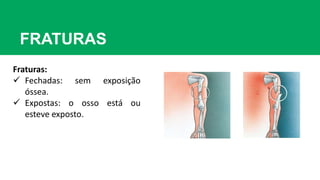 FRATURAS
Fraturas:
 Fechadas: sem exposição
óssea.
 Expostas: o osso está ou
esteve exposto.
 
