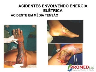 ACIDENTE EM MÉDIA TENSÃO
ACIDENTES ENVOLVENDO ENERGIA
ELÉTRICA
 