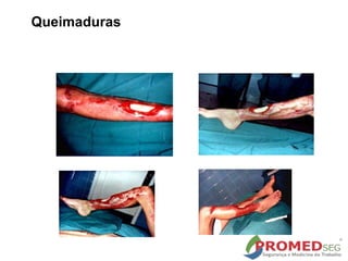 Queimaduras
 