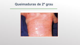 Queimaduras de 2º grau
 