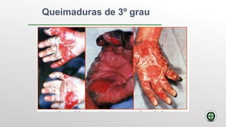 Queimaduras de 3º grau
 