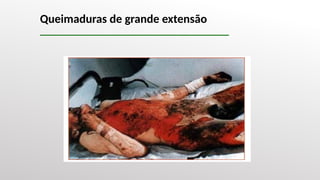 Queimaduras de grande extensão
 
