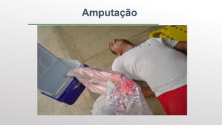 Amputação
 