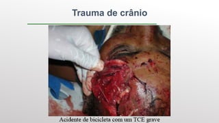 Trauma de crânio
 