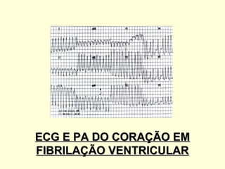 ECG E PA DO CORAÇÃO EM
FIBRILAÇÃO VENTRICULAR
 