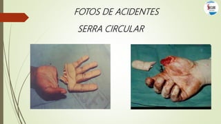FOTOS DE ACIDENTES
SERRA CIRCULAR
 