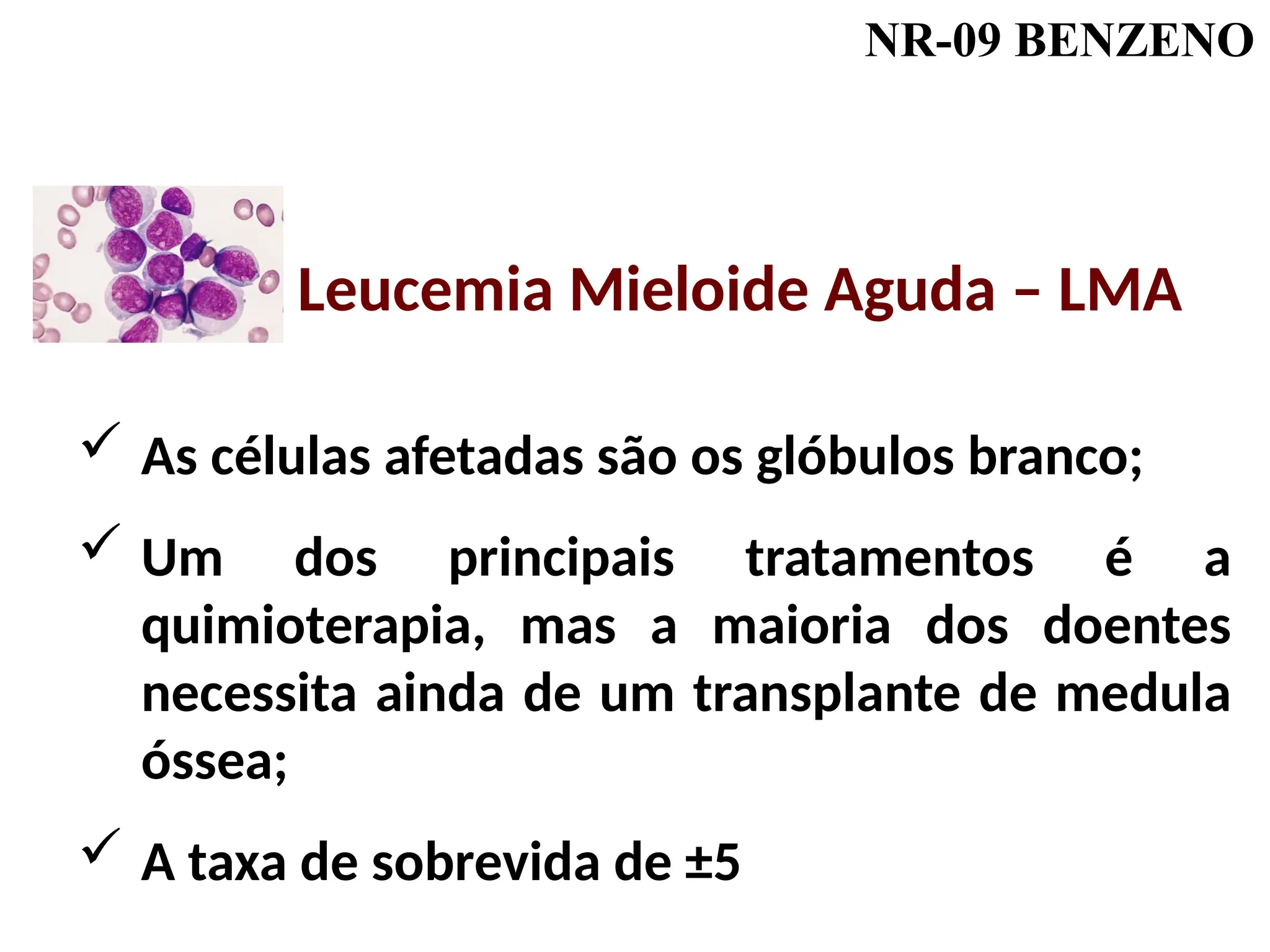 NR-09 BENZENO
 As células afetadas são os glóbulos branco;
 Um dos principais tratamentos é a
quimioterapia, mas a maioria dos doentes
necessita ainda de um transplante de medula
óssea;
 A taxa de sobrevida de ±5
Leucemia Mieloide Aguda – LMA
 