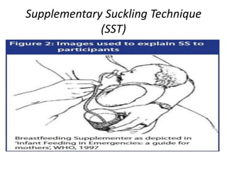 Supplementary Suckling Technique
(SST)
 
