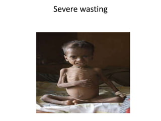 Severe wasting
 