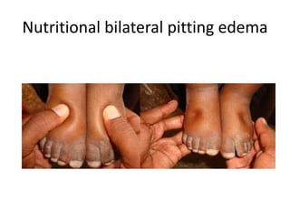 Nutritional bilateral pitting edema
 