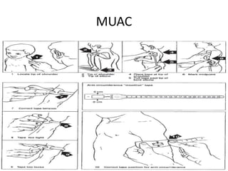 MUAC
 