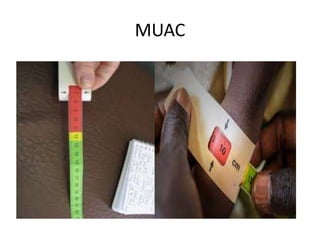 MUAC
 