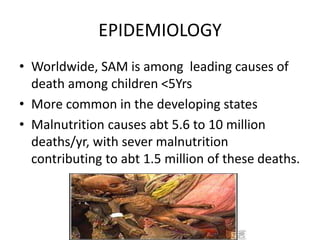 EPIDEMIOLOGY
• Worldwide, SAM is among leading causes of
death among children <5Yrs
• More common in the developing states
• Malnutrition causes abt 5.6 to 10 million
deaths/yr, with sever malnutrition
contributing to abt 1.5 million of these deaths.
 