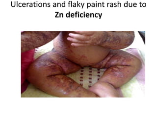 Ulcerations and flaky paint rash due to
Zn deficiency
 