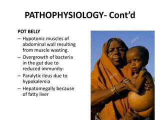 PATHOPHYSIOLOGY- Cont’d
POT BELLY
– Hypotonic muscles of
abdominal wall resulting
from muscle wasting.
– Overgrowth of bacteria
in the gut due to
reduced immunity-
– Paralytic ileus due to
hypokalemia
– Hepatomegally because
of fatty liver
 